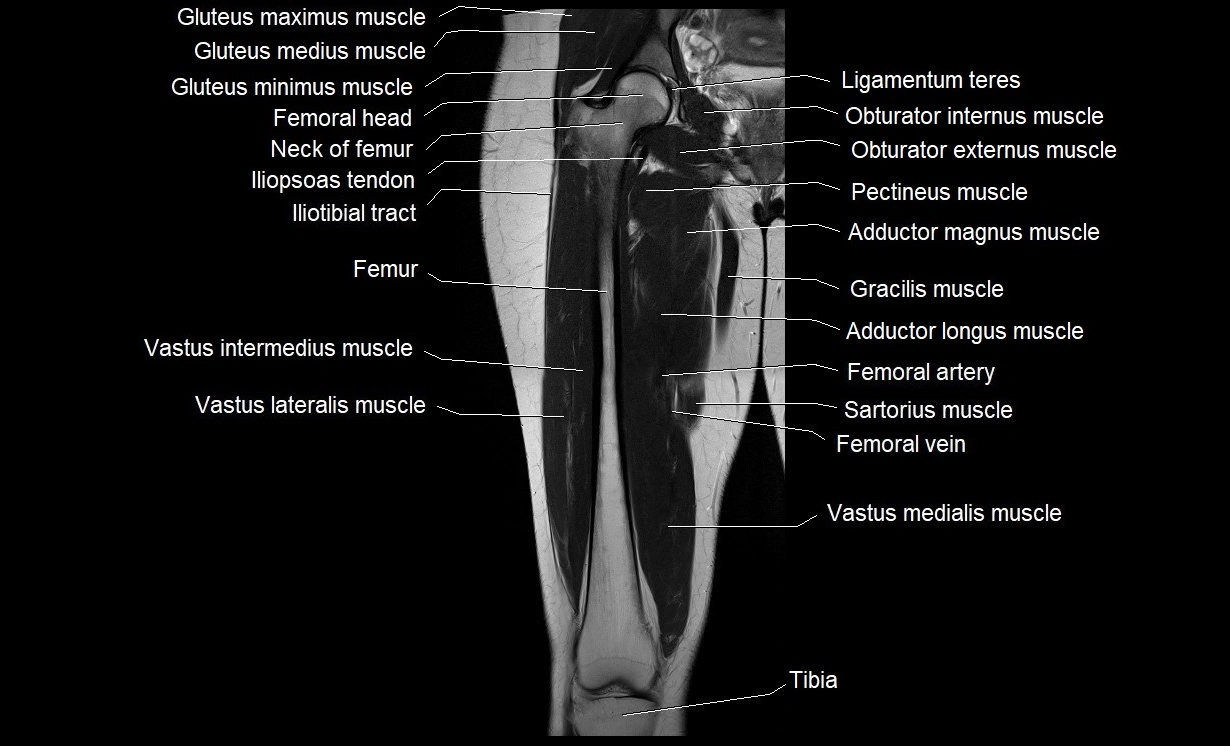 MRI thigh coronal cross sectional anatomy image 11.webp